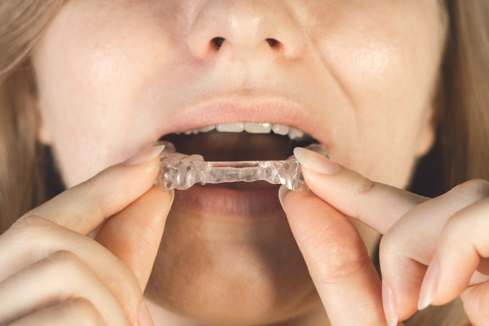 Woman puts dental guard in her mouth