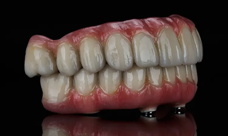 Implant-supported dental bridge