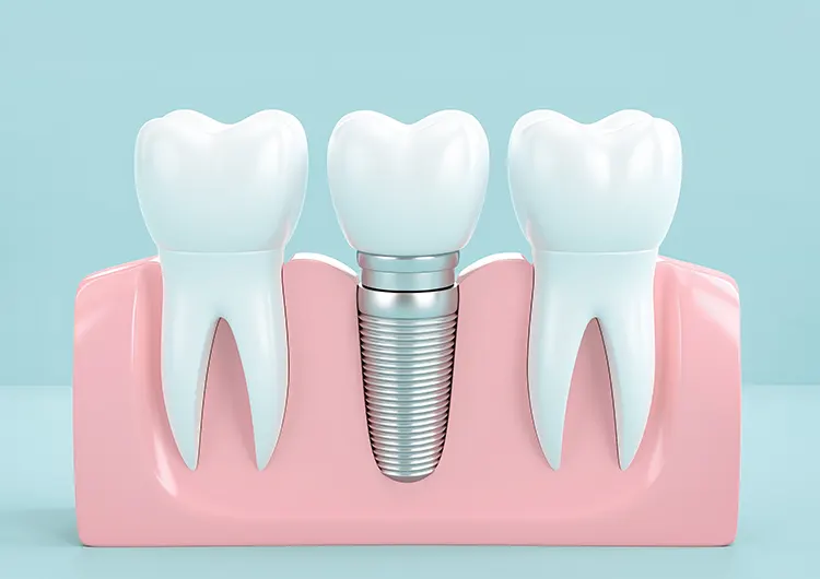 Dental jaw model with a tooth implant