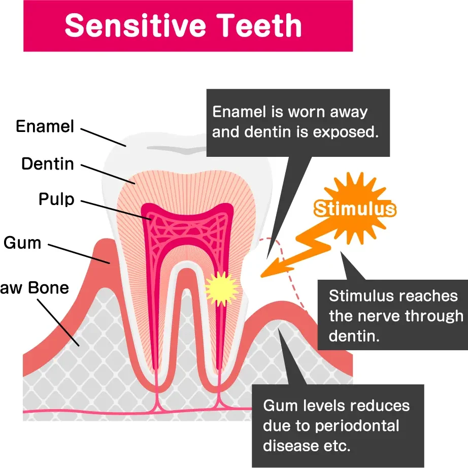 Sensitive teeth – symptoms & causes of dentin hypersensitivity, diagnosis and treatment
